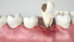 Emergency Tooth Extraction In Houston