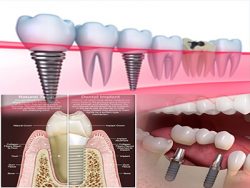 Cosmetic Dental Treatment