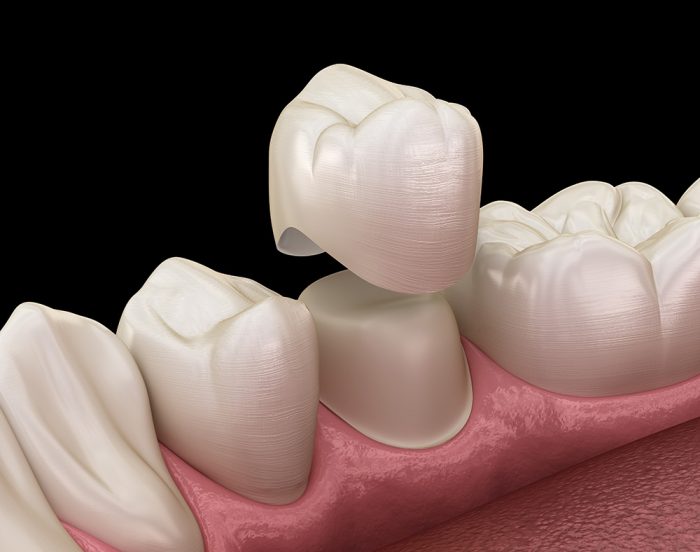 Crown Dental near me in Houston, TX | Affordable Tooth Crown