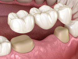 Crown Dental near me in Houston, TX | Affordable Dentures