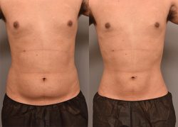 Brazilian Butt Lift Surgery Before After