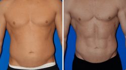 Laser Fat Removal Options, Costs, Results