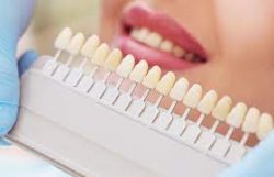 Professional Teeth Whitening | Teeth Whitening Houston