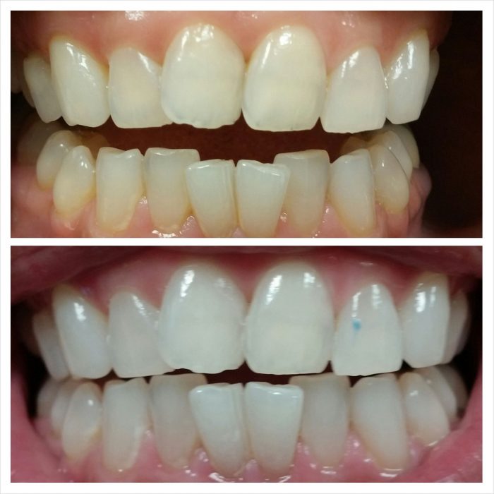 Teeth Whitening Near Me in Houston