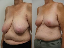 Before and After Breast Lift Surgery