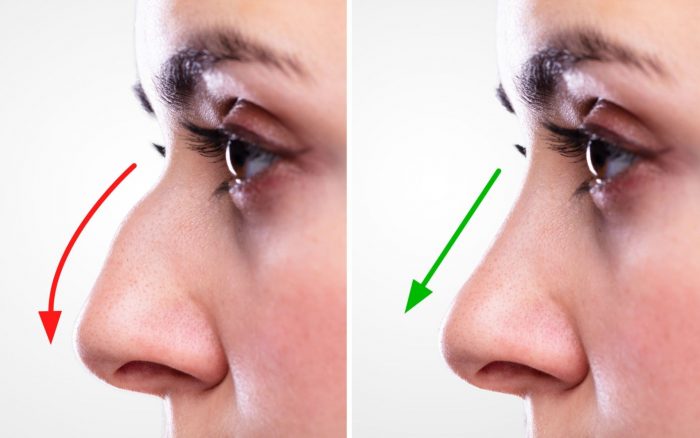 Nose Plastic Surgery Near Me