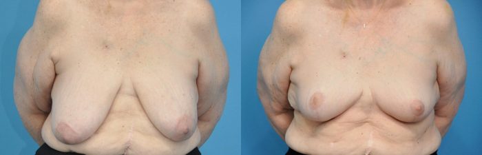 Before And After Breast Reduction Surgery