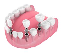 Dental Implants in Sunny Isles Beach | Dental Center