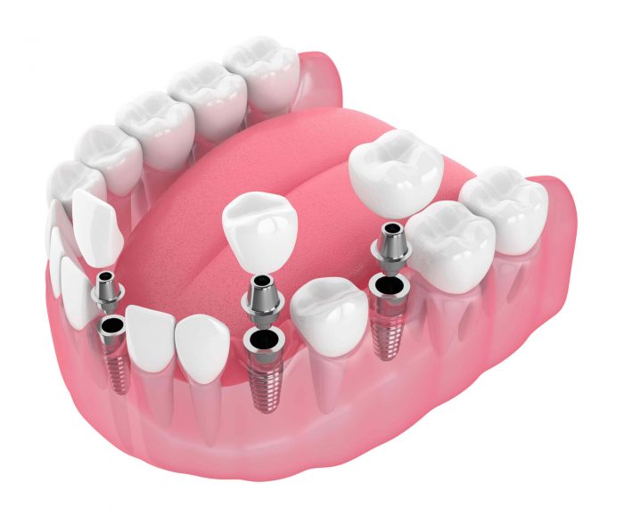 Dental Implants in Sunny Isles Beach | Dental Center