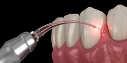 Laser Dentistry Near Me | Dental Laser Treatment