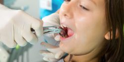 Root Canal Treatment in Houston tx