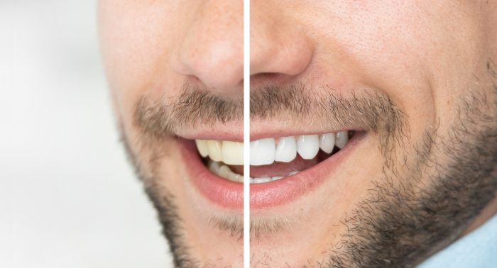 Cosmetic tooth bonding