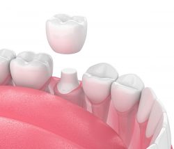 Which Is The Best Dental Crown To Get? | Types of dental crowns
