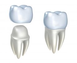 Which Is The Best Dental Crown To Get? | types of dental crowns and cost