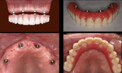 All On 4 Dental Implants Near Me | Full Mouth Implant Treatment