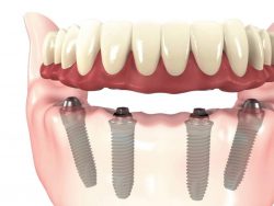 All On 4 Dental Implants Near Me | Full set of teeth or All new teeth on dental implants