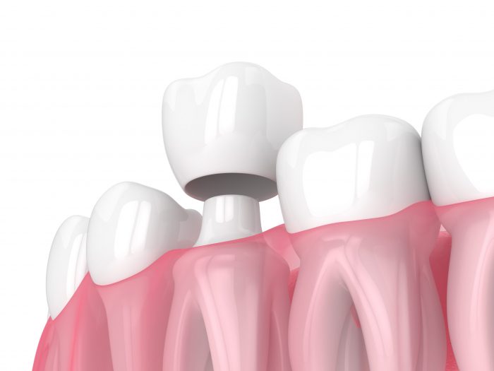 Dental Crown Replacement in Houston, TX | Dental Crowns Houston TX