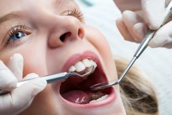 Dental Sealant for Children