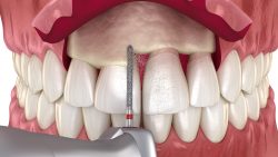 Dental Crown Lengthening Procedure | Dental Crown Lengthening Treatments