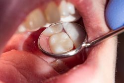 Tooth Cavity Filling | Fix Chipped & Broken Tooth Filling