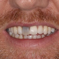 Benefits of Dental Crown Procedure | Advantages and Disadvantages of Dental Crowns