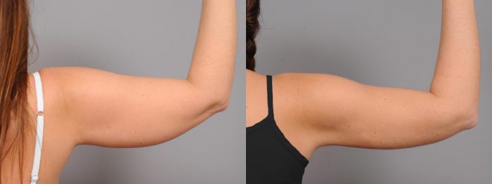 Arm Liposuction in Houston | Arm Lipo