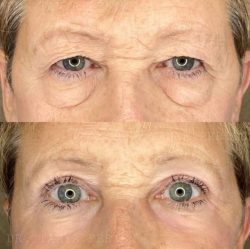 How Much Does Eye Lift Surgery Cost? | Ageing Eyelid Surgery