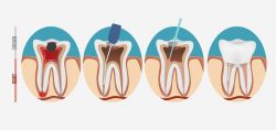 root canal treatment in Sunny Isles Beach | Root Canals Near Me