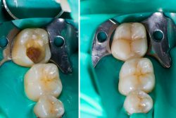 Do you have a lost filling or crown? | Lost Fillings or Crown Emergency Treatment