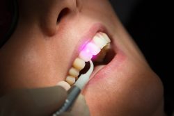 Laser Dental Office In Houston, TX | Laser Teeth Whitening