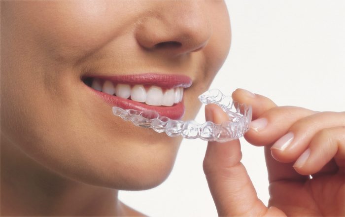 Invisalign Clear Aligners | invisible braces