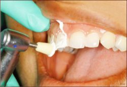 Teeth Cleaning Dentist Near Me | Teeth Whitening Services