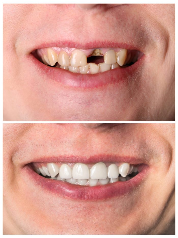 Dental Bonding Before And After | Cosmetic Dental Bonding