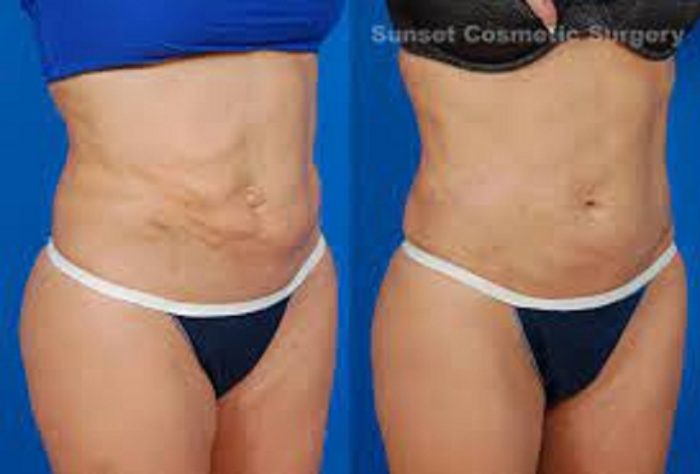 Treating BBL Lipo Scars