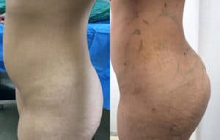 Brazilian Butt Lift Surgery?