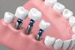 Dental Implants Sunny Isles