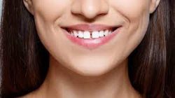 Veneers For Gap Teeth | Fix Front Teeth Gap in Houston
