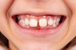 For Gap Teeth | Fix Front Teeth Gap in Houston