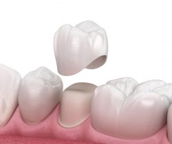 Which Is The Best Dental Crown To Get? | best material to get dental crown