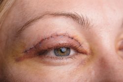 How Much Does Eye Lift Surgery Cost? | Eyelid Surgery Cost