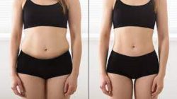 Does Laser Lipo Work?