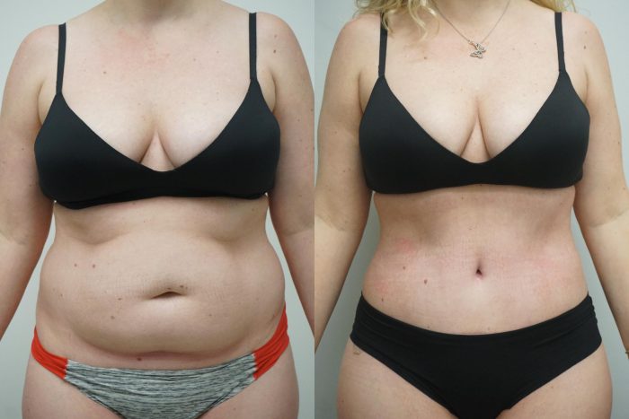 Tummy Tuck Before & After Pictures