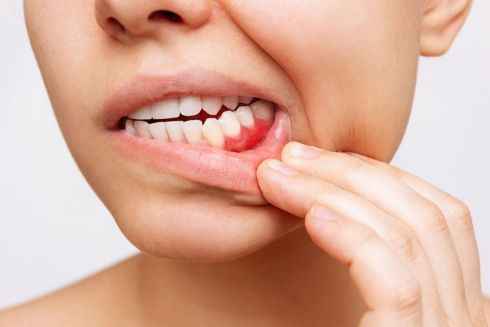 What Causes Swollen Gums? | Get Rid Of Swollen Gums?