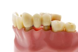 What are Dental Crowns and Tooth Bridges? | dental bridge