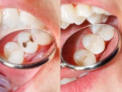 What are the advantage of Composite Fillings? | Composite Fillings Benefits