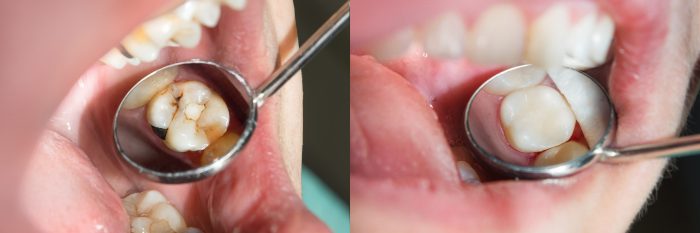 What are the advantage of Composite Fillings? | disadvantages of amalgam fillings