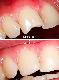 What is The Best Cracked Tooth Treatment? | Cracked Teeth