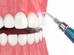 What Is A Laser Gingivectomy?