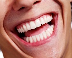 Cosmetic Dental Bonding | Teeth Bonding Cost