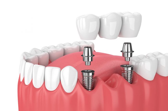 Cosmetic Dental Bridge | Affordable Dental Bridge Houston